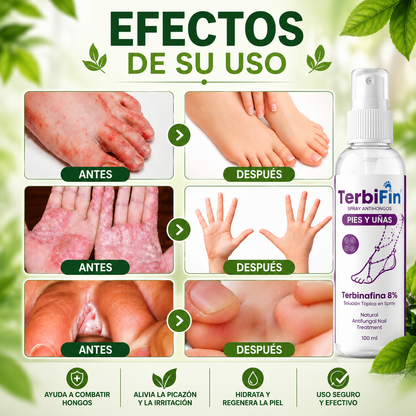 Terbifin Spray Antihongos 8% Terbinafina